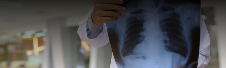 Asbestosis