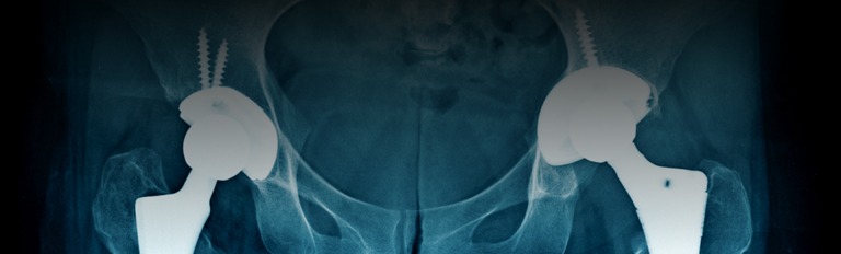 Hip Replacement